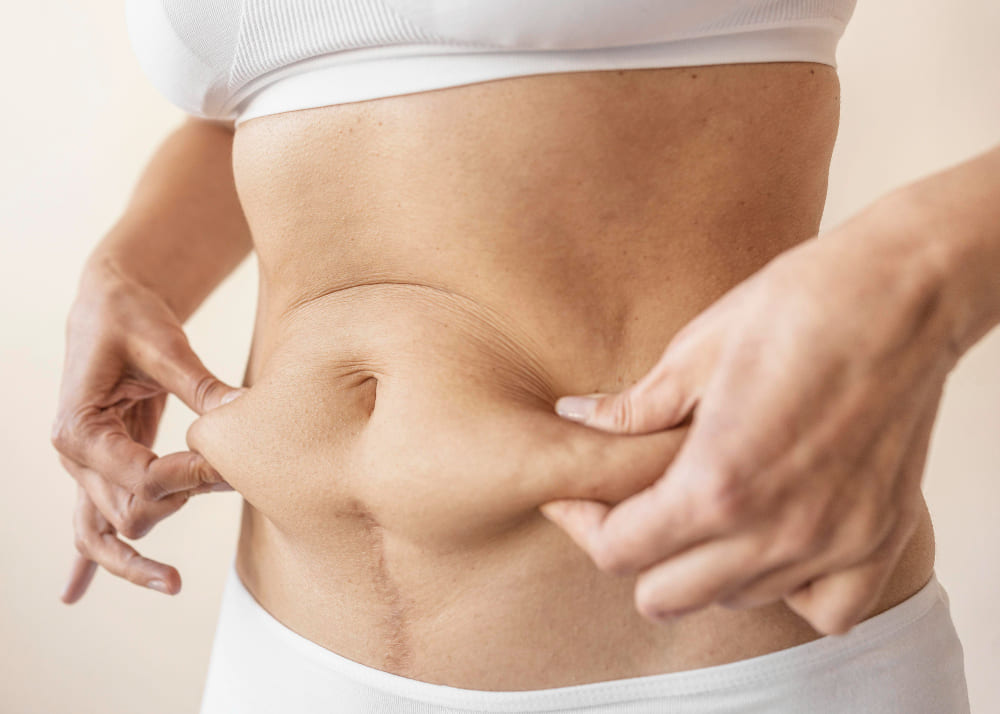 CIRURGIA DE BYPASS GÁSTRICO