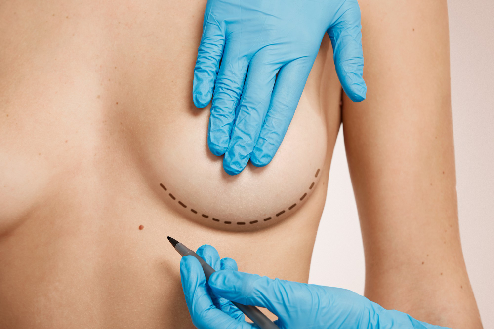 CIRURGIA MAMÁRIA