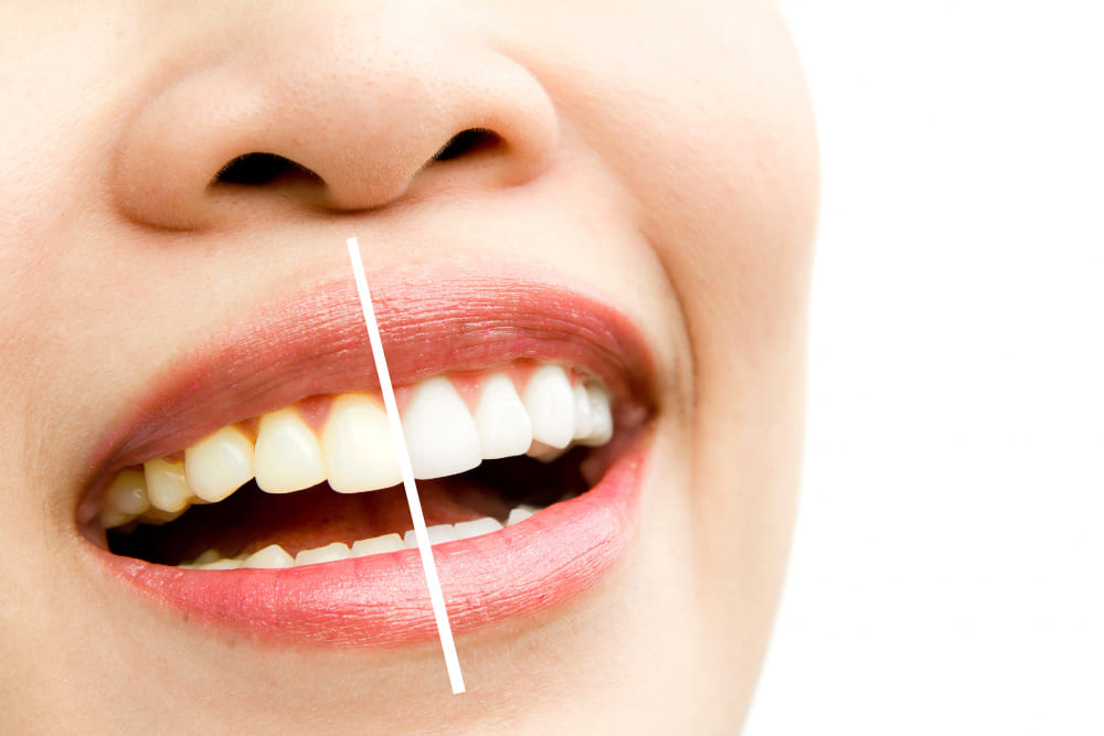 CLAREAMENTO DENTAL